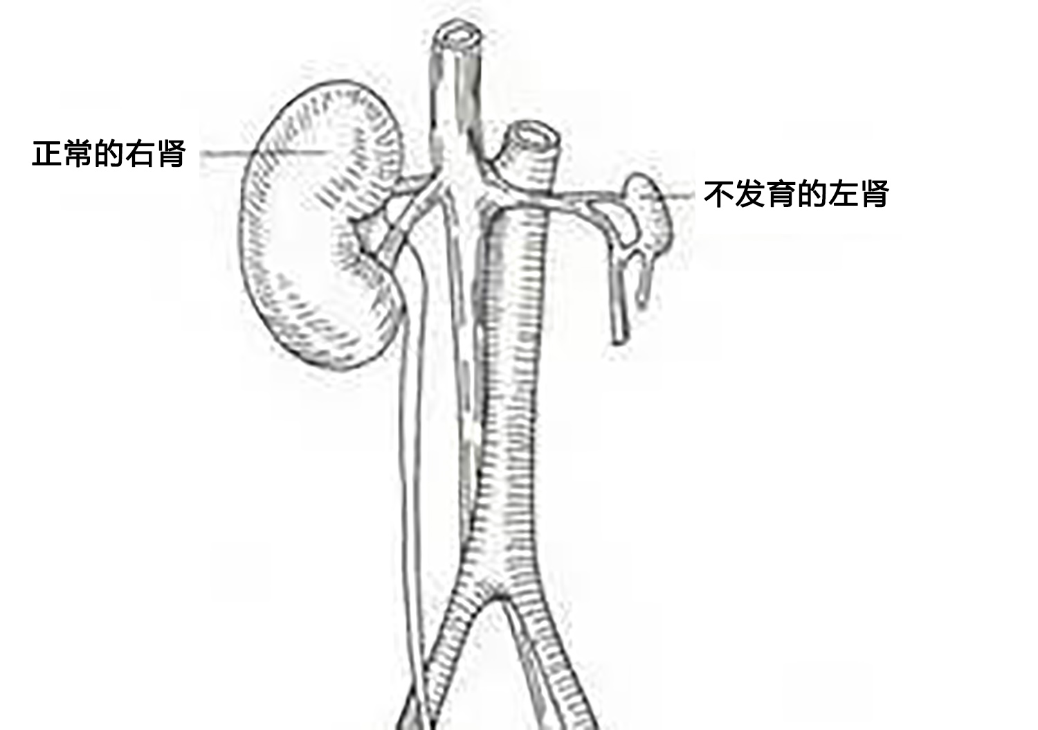 24岁女生入职体检查出少一个肾，人体只有一个肾会怎样？