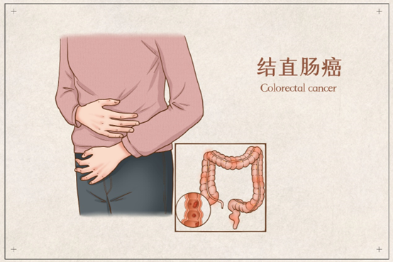 JAMA：2型糖尿病可能导致患结肠癌的风险增加